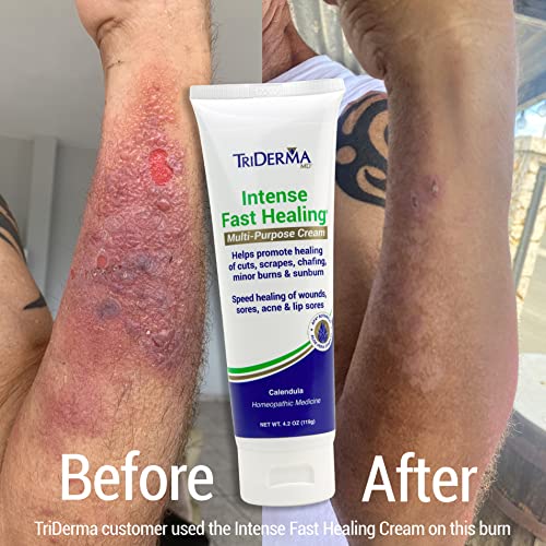 TriDerma Intense Fast Skin Healing Cream for Hard-to-Heal Skin Irritations, Sores, Rashes, Dry, Cracked Hands, Cuts, Chafing, Burns, Scrapes - First Aid Kit Essential - FSA Eligible - 4.0 oz Tube