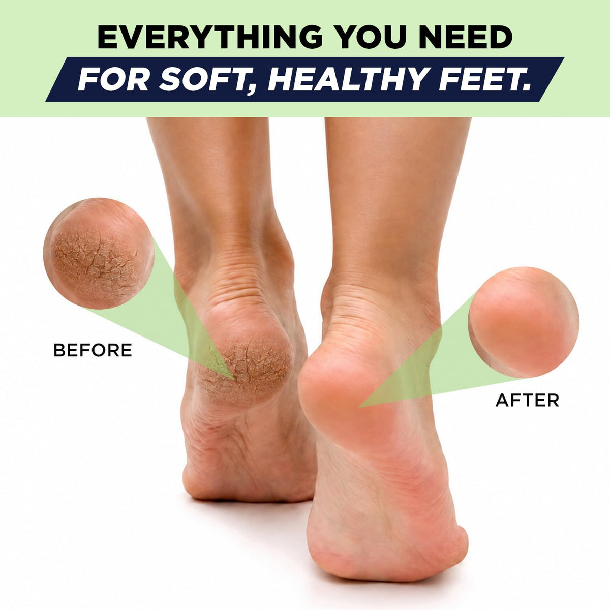 Antifungal Cream for Athletes Foot, Jock Itch, Ringworm, Dry Cracked Heel