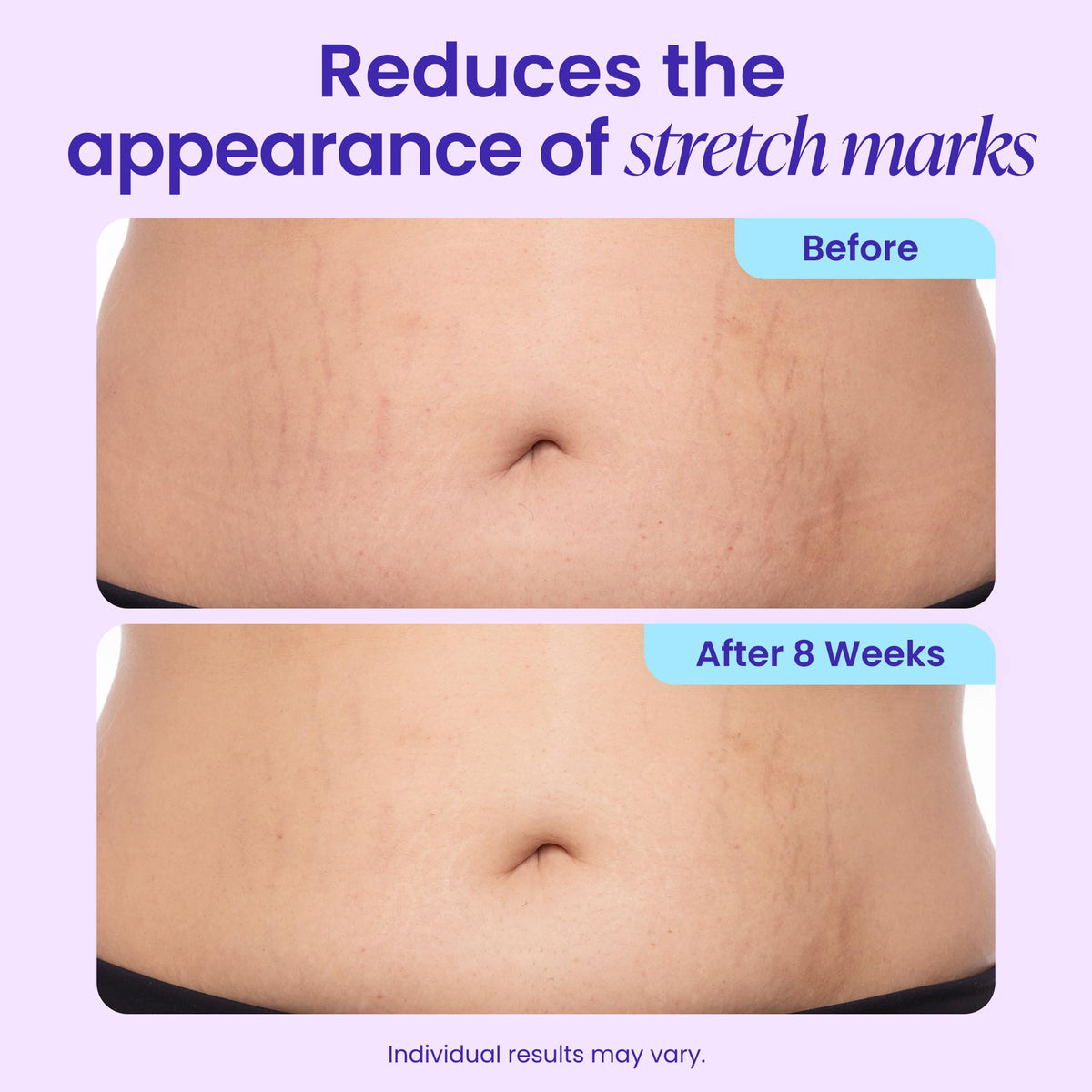 GOPURE Tighten & Smooth Belly Cream - Clinically Tested with MicroTight4 Complex to Reduce the Appearance of Cellulite & Stretch Marks - Quick Absorbing for Smoother, Firmer-Looking Skin, 4.25oz