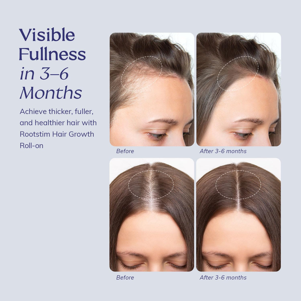 RootStim Hair Growth Serum Roll On with Rosemary, Caffeine & Biotin, Helps Support Fuller-Looking Hair, Clean Non-Greasy Scalp Serum for Thinning Hair 1.08 Fl Oz