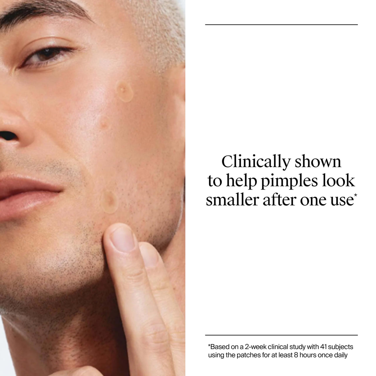 Neutrogena Stubborn Acne Patches, Ultra-Thin Pimple Patches, 24 Ct