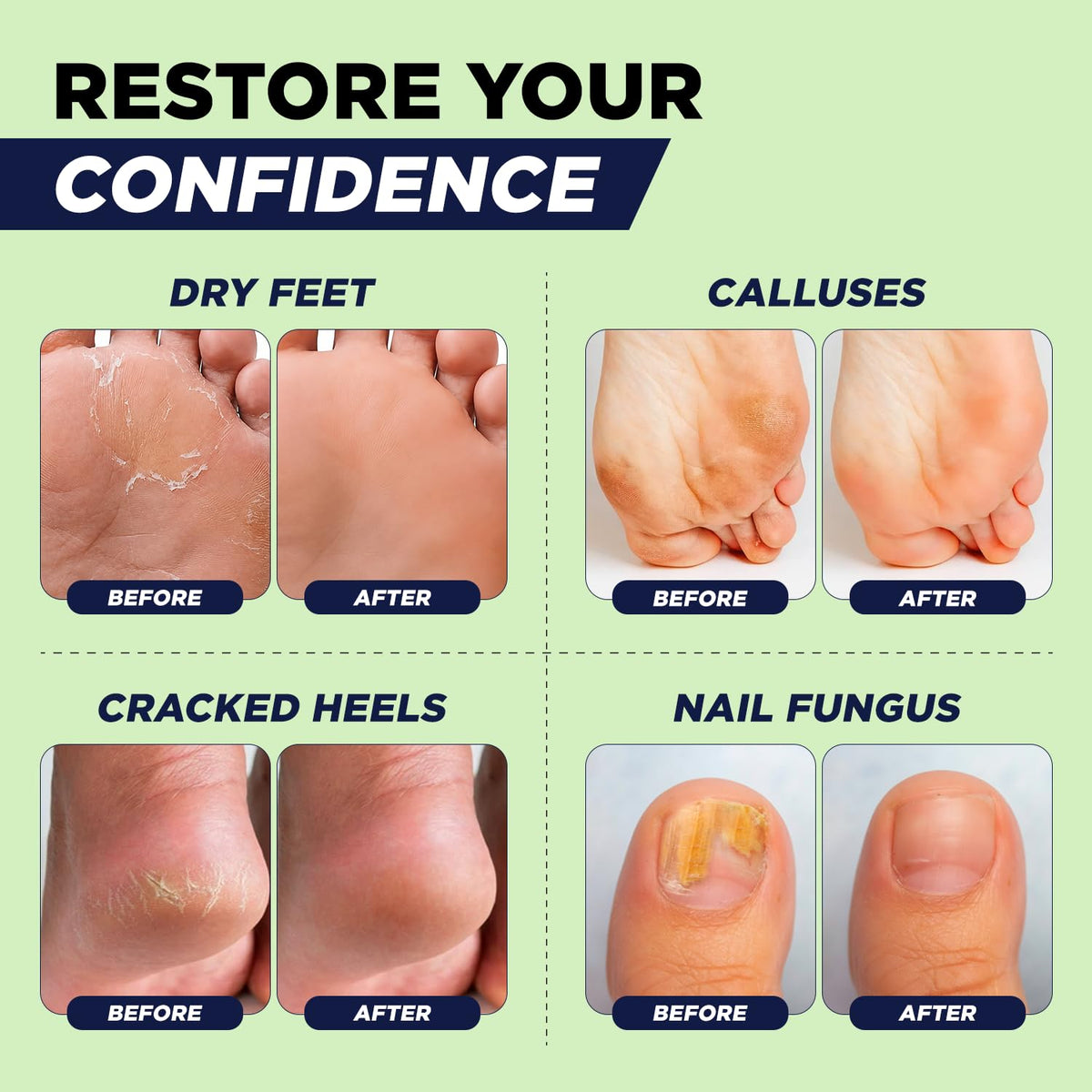 Tea Tree Oil Epsom Salt Foot Soak for Toenail Fungus Treatment, Tired Feet