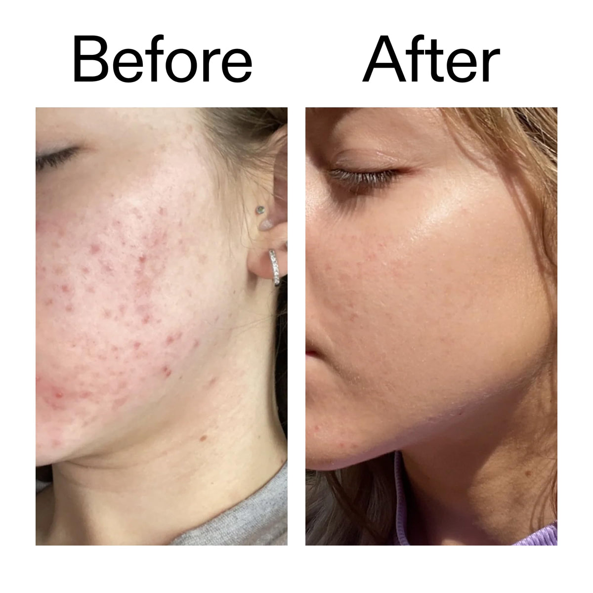 The INKEY List 10% Niacinamide Serum, Lightweight Oil Control Serum Helps with Blemishes and Appearance of Redness, Hydrating 1% Hyaluronic Acid 30ml