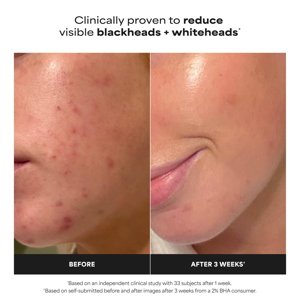 Paula's Choice SKIN PERFECTING 2% BHA Liquid Leave-On Exfoliant, 4 Fl Oz
