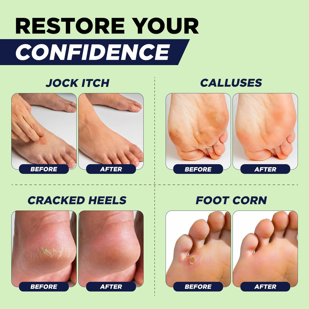 Antifungal Cream for Athletes Foot, Jock Itch, Ringworm, Dry Cracked Heel