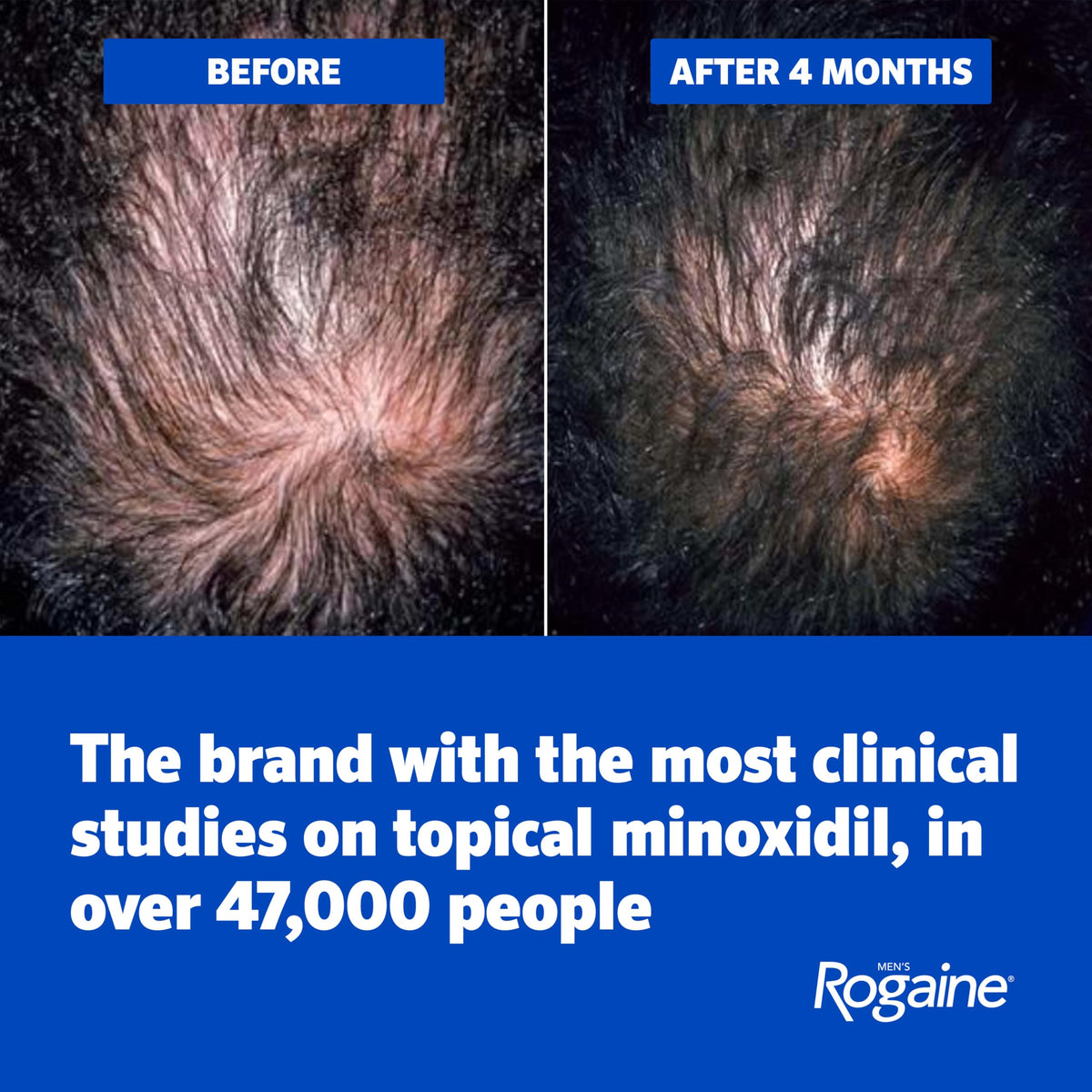 Men's Rogaine 5% Minoxidil Topical Foam, Unscented, 3 Mo Supply, 3x 2.11 Oz
