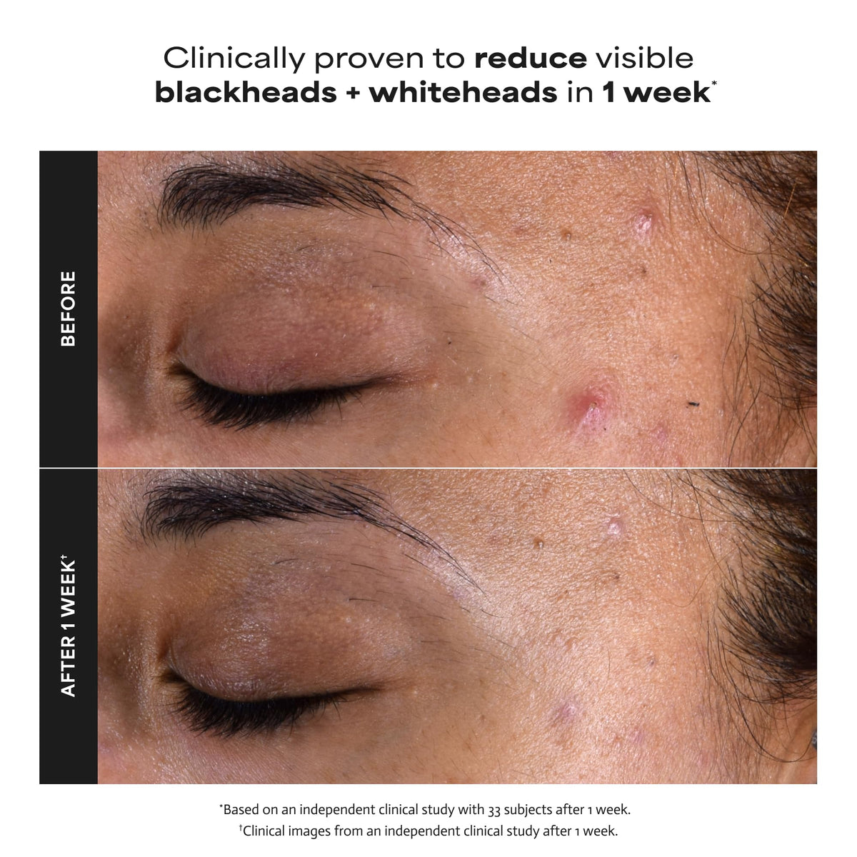 Paula's Choice SKIN PERFECTING 2% BHA Liquid Leave-On Exfoliant, 1 Fl Oz
