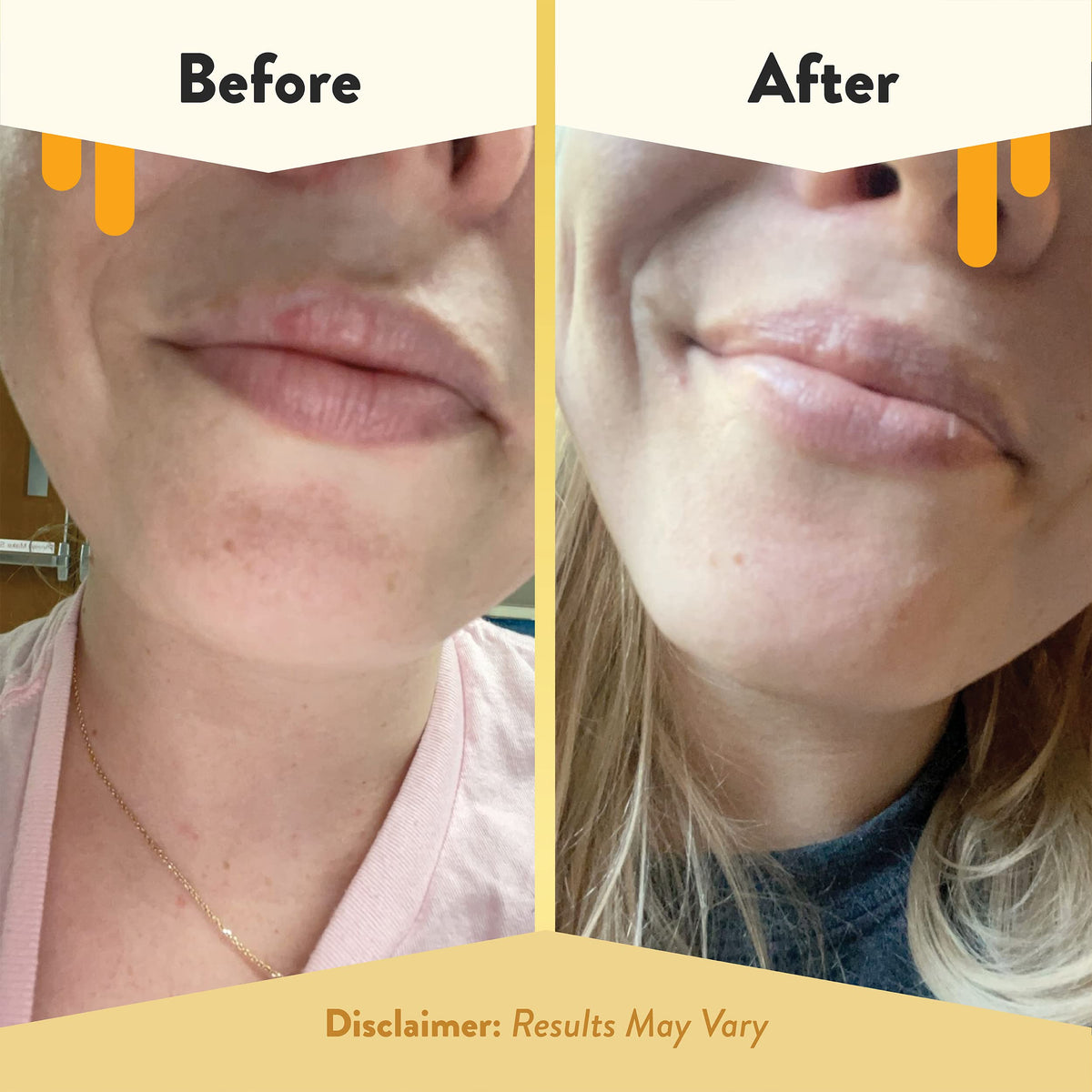ECZEMA HONEY Nourishing Lip Balm, Daily Lip Moisturizer for Dry Lips (1 Ct)