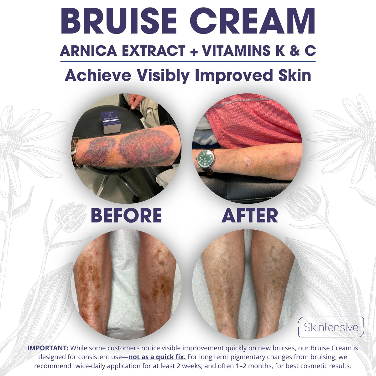 SKINTENSIVE Arnica Bruise Cream for Thin Skin – Vitamin K Cream for Bruises & Skin Discoloration, Moisturizing Arnica Cream, Non-Greasy Formula, 4 Oz