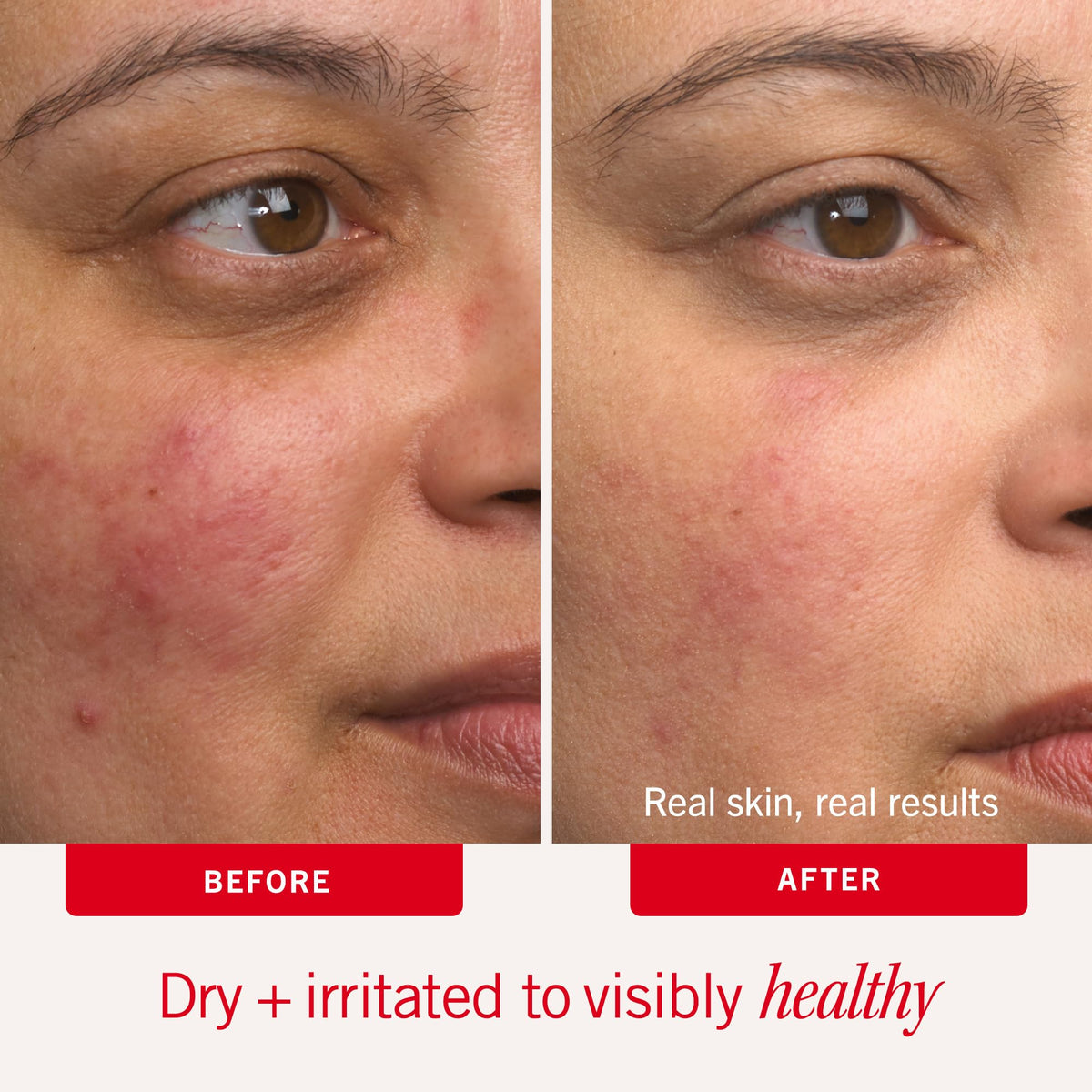First Aid Beauty Ultra Repair Cream, Intense Hydration, 4 oz