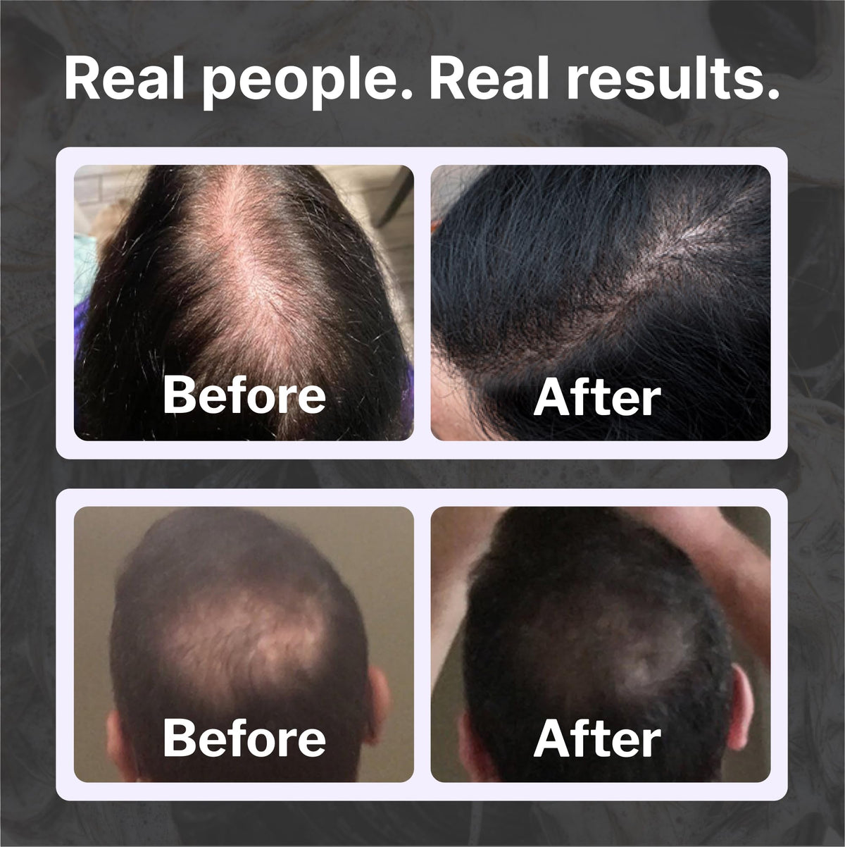 Shapiro MD Hair Growth Experts DHT Fighting Hair Loss Shampoo, 2 Month